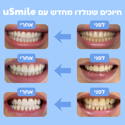 מארז ההלבנה של uSmile